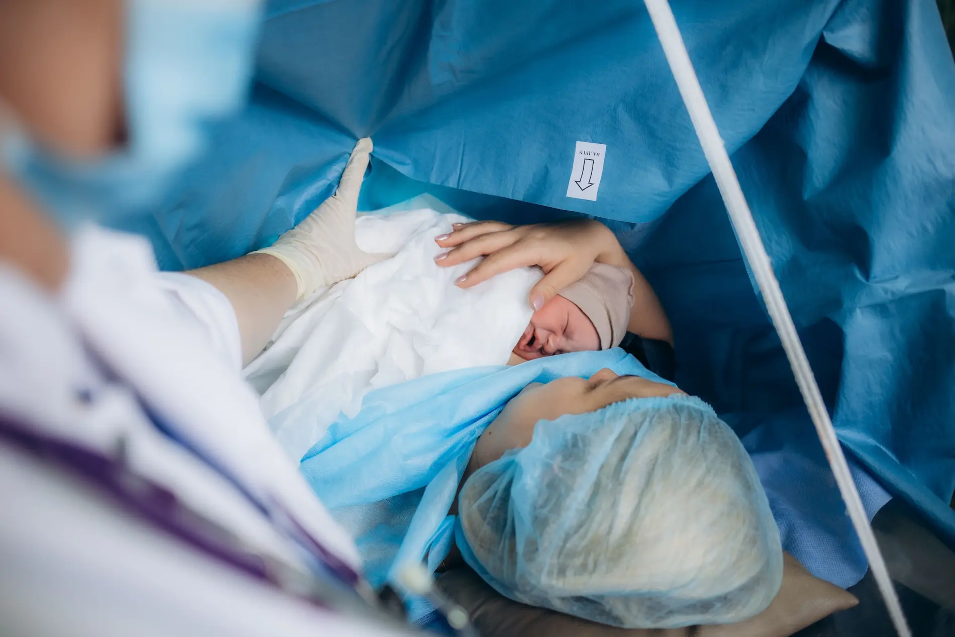 Mother skin-to-skin with baby after cesarean birth